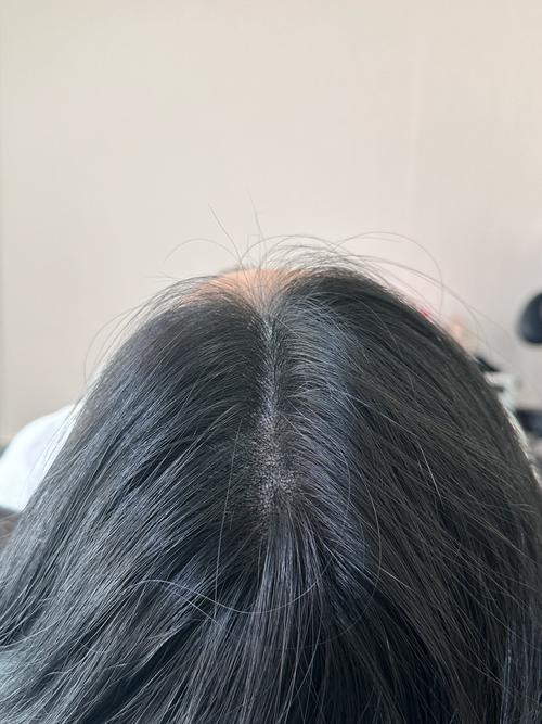 用生发液迟迟没效果，避开这些使用误区，IUTANA健发液注意事项请查收
